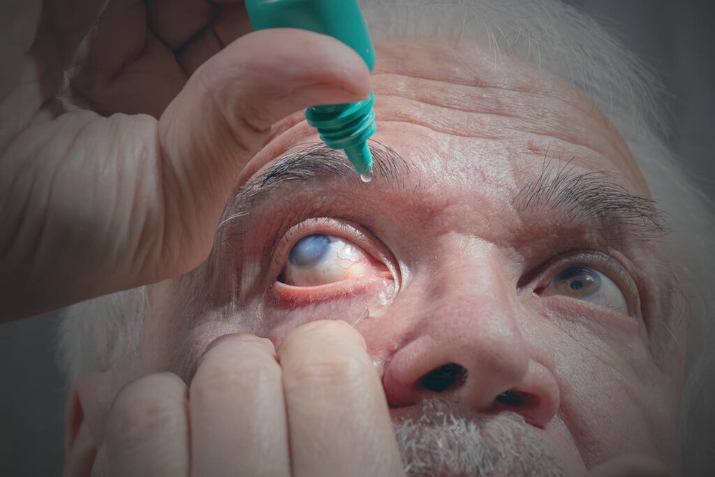 Fotografia de pessoa pingando colírio no olho, pelo Dia Nacional de Combate ao Glaucoma 2021.