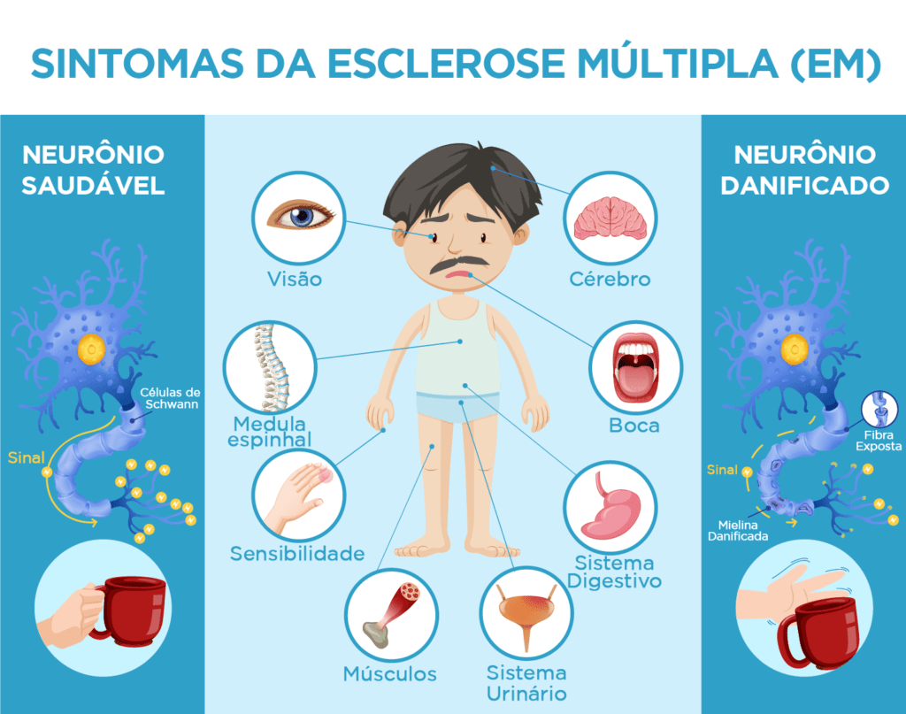 Ilustração sobre os Sintomas da Esclerose Múltipla (EM), com descrição detalhada na legenda, abaixo.