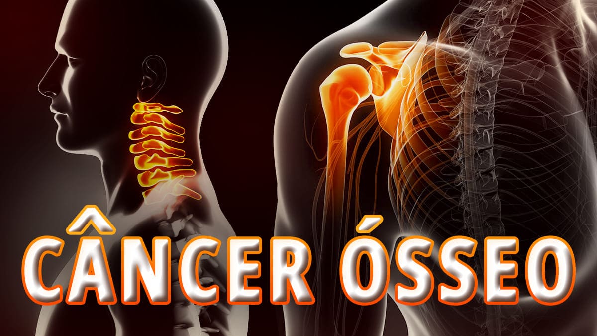 Imagem digital simulando raio-x de pescoço e de ombro com luzes em tons de laranja em partes dos ossos e o texto: “Câncer ósseo”.