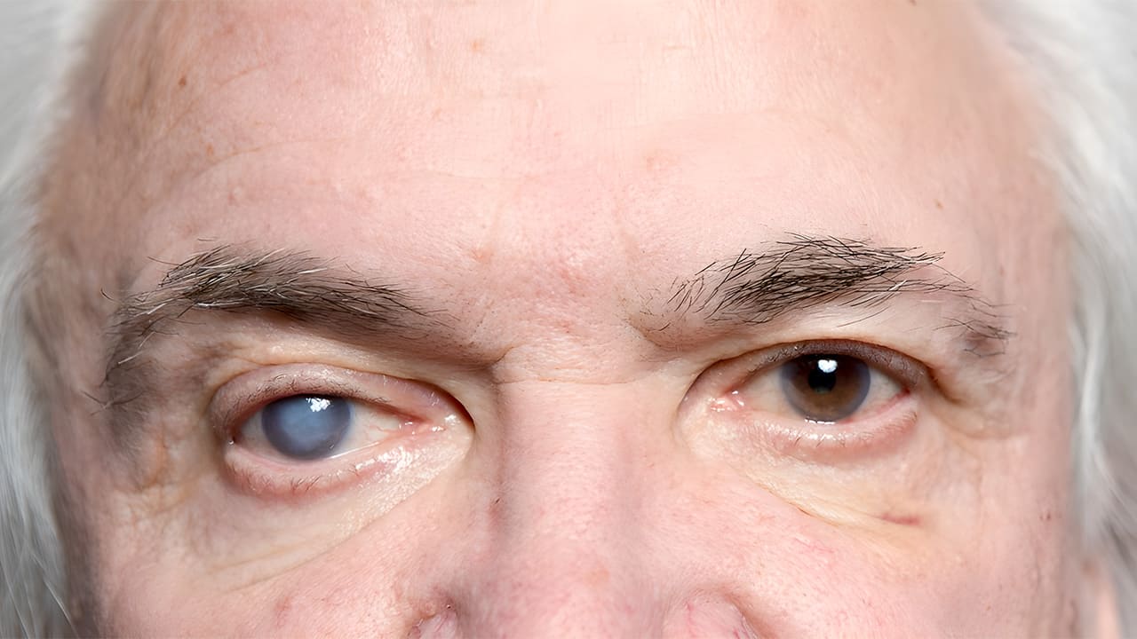 Pessoa de cabelo grisalho acometida pelo Glaucoma no olho direito. Foto mostra em detalhe a coloração do olho afetado.