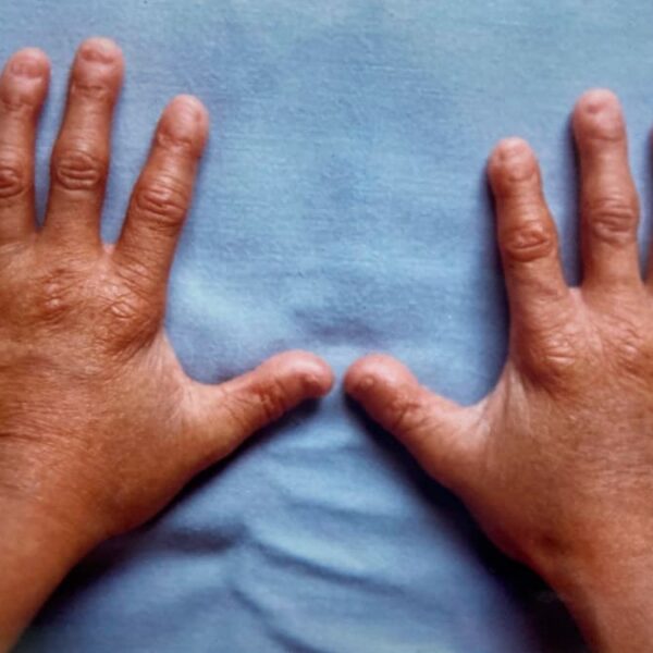 Mãos de uma pessoa com progéria, síndrome retratada no filme Benjamin Button, sobre um fundo azul.
